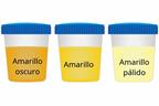 Three cups showing dark yellow, yellow, and pale yellow urine.