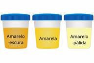 A comparison of three sample cups showing dark yellow, yellow, and pale yellow urine.