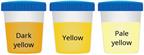 A comparison of three sample cups showing dark yellow, yellow, and pale yellow urine.