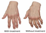 Two hands showing treated versus untreated rheumatoid arthritis. 