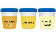 A comparison of three sample cups showing dark yellow, yellow, and pale yellow urine.