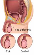An inside view of the male body, showing a vasectomy. 