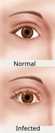 A normal eye compared to an eye with bacterial conjunctivitis.