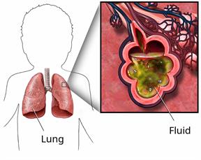 Outline of a child's upper body showing the lungs, with a close-up of fluid in the lungs.