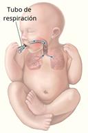 A baby with a breathing tube passed through the mouth and into the windpipe, showing air going to the lungs.