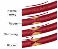 Series of blood vessels showing a gradual buildup of plaque that causes the blood vessel to become narrow and then blocked.