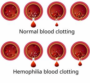 Series of blood vessels showing normal blood clotting compared to blood clotting with hemophilia.