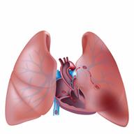 Blood clot in the blood vessels of the lungs.