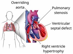 The heart inside the body with a close-up of the 4 heart defects that make up tetralogy of Fallot. 