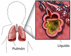 Outline of a child's upper body showing the lungs, with a close-up of fluid in the lungs.
