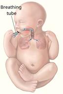 A baby with a breathing tube passed through the mouth and into the windpipe, showing air going to the lungs.