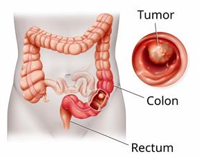 Outline of the belly area showing the colon and rectum with a close-up of a tumor in the colon. 