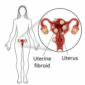 Outline of a female body, with a close-up of fibroids in the uterus.