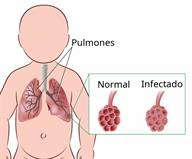 An outline of a baby with a view of the lungs and a close-up of part of a lung that is normal, and the same part infected.