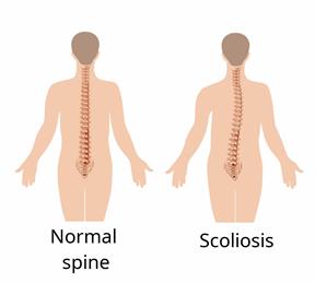 A normal spine compared to a spine with scoliosis. 
