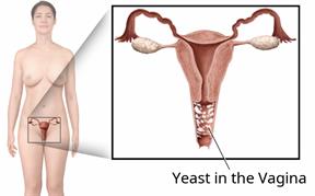 Female body with a close-up showing the vagina with a yeast infection.