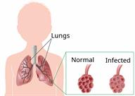 An outline of a child with a view of the lungs and a close-up of part of a lung that is normal, and the same part infected.
