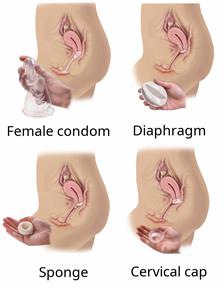 Female contraception options including a female condom, a diaphragm, a sponge, and a cervical cap.