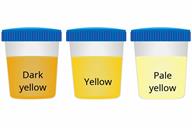 A comparison of three sample cups showing dark yellow, yellow, and pale yellow urine.