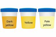 A comparison of three sample cups showing dark yellow, yellow, and pale yellow urine.