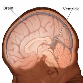 Side view of an infant's brain showing the brain and ventricle.
