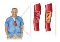 The heart in a person's body with a close-up of a normal blood vessel and a blood vessel with plaque buildup.