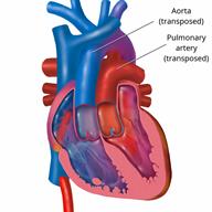 The heart showing the aorta and pulmonary artery in a reversed, or transposed, position.