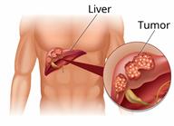 A person with an internal view of a liver with cancer. A close-up shows a tumor on the liver.