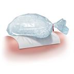 A bag of ice on a towel on the skin.