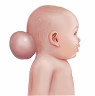 Side view of an infant with an encephalocele sticking out from the back of the skull.