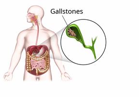 Body outline showing the digestive system with a close-up of the gallbladder with gallstones in it. 