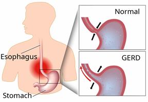 Body outline showing the esophagus and stomach, with 2 close-ups showing how reflux happens.