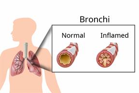A comparison between normal and inflamed airways, or bronchi, in the lungs.