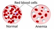 Comparison of blood with a normal amount of red blood cells to blood with fewer red blood cells when a person has anemia.