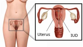 Lower body outline showing the female reproductive organs with a close-up view of an IUD in the uterus.