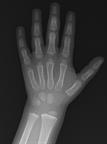 An X-ray showing the lower arm, wrist, and hand.