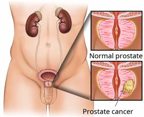 Male lower body area with close-ups showing normal prostate and prostate cancer.