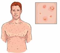 A person with mpox, with a close-up of blisters on the skin.