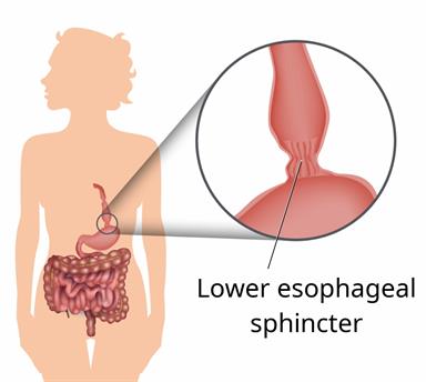 Body outline showing the stomach, esophagus, and intestines, with a close-up of a tight lower esophageal sphincter.