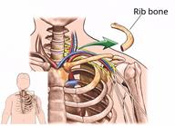 A person's shoulder area, with a close-up showing the removal of a small rib bone near the thoracic outlet.