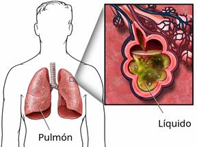 Outline of a person's upper body showing the lungs, with a close-up of fluid in the lungs.