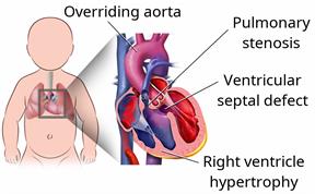 The heart inside an infant's body with a close-up of the four heart defects that make up tetralogy of Fallot.