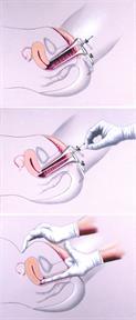 A speculum inserted in the vagina, a Pap test being done, and a gloved finger inserted into the vagina during a pelvic exam.
