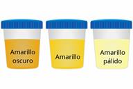A comparison of three sample cups showing dark yellow, yellow, and pale yellow urine.