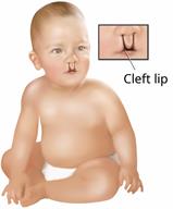 A baby with a bilateral cleft lip, also showing a close-up of the cleft lip.