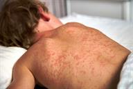 A child with a red rash on their back.