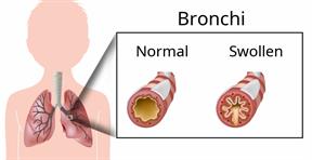 Outline of a child's upper body showing the lungs, with a close-up of two bronchi, one normal and one swollen.