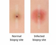 Two puncture sites for biopsy. One is normal and the other is red with pus. 