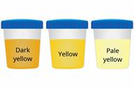 A comparison of three sample cups showing dark yellow, yellow, and pale yellow urine. 
