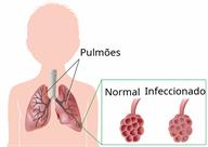 An outline of a child with a view of the lungs and a close-up of part of a lung that is normal, and the same part infected.